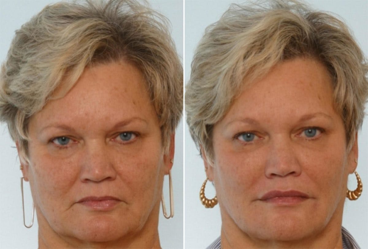Fillers Before & After Gallery - Patient 55119278 - Image 1