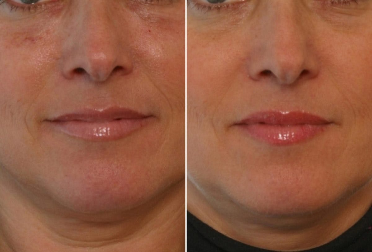 Fillers Before & After Gallery - Patient 55119279 - Image 1