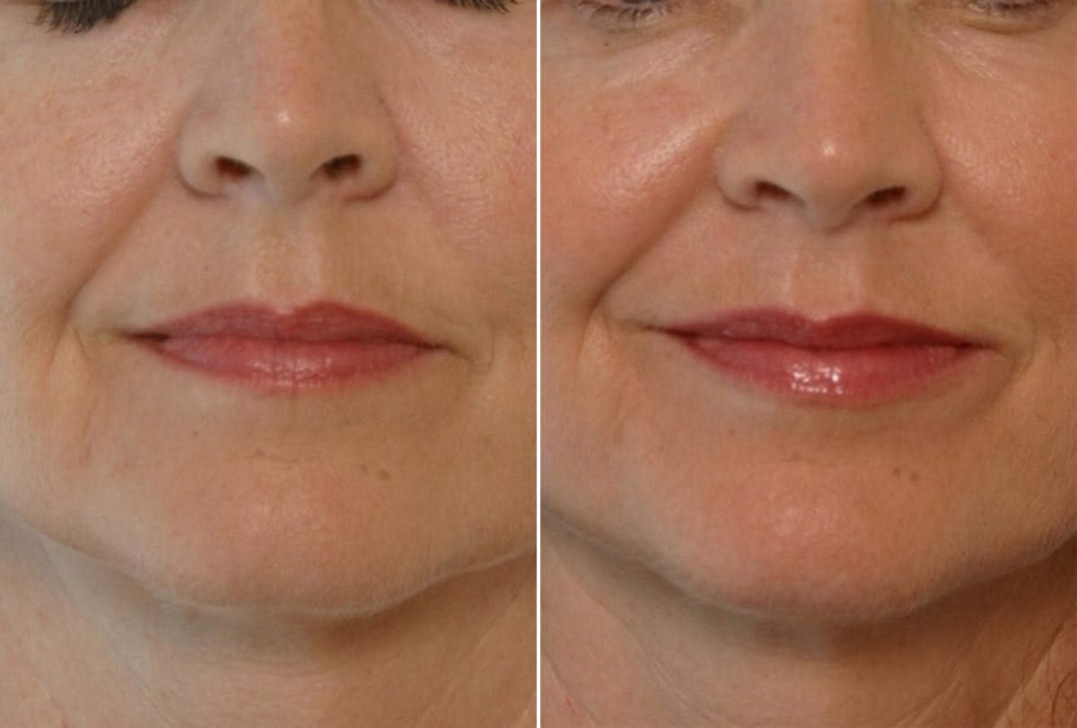 Fillers Before & After Gallery - Patient 55119280 - Image 1