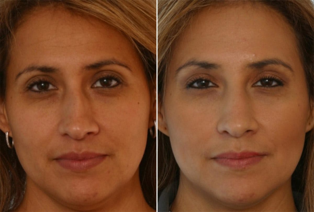 Fillers Before & After Gallery - Patient 55119283 - Image 1