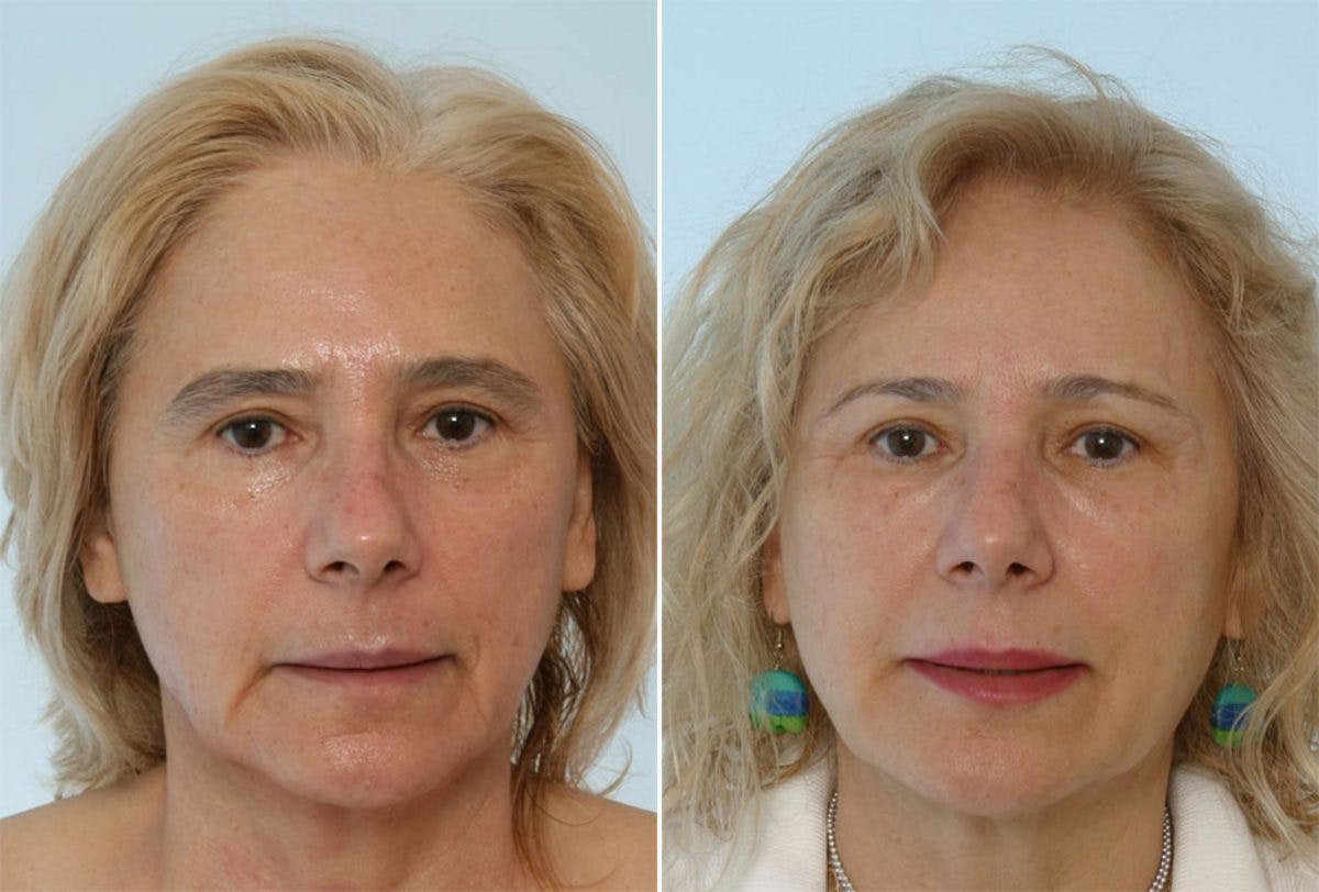 Fillers Before & After Gallery - Patient 55119284 - Image 1