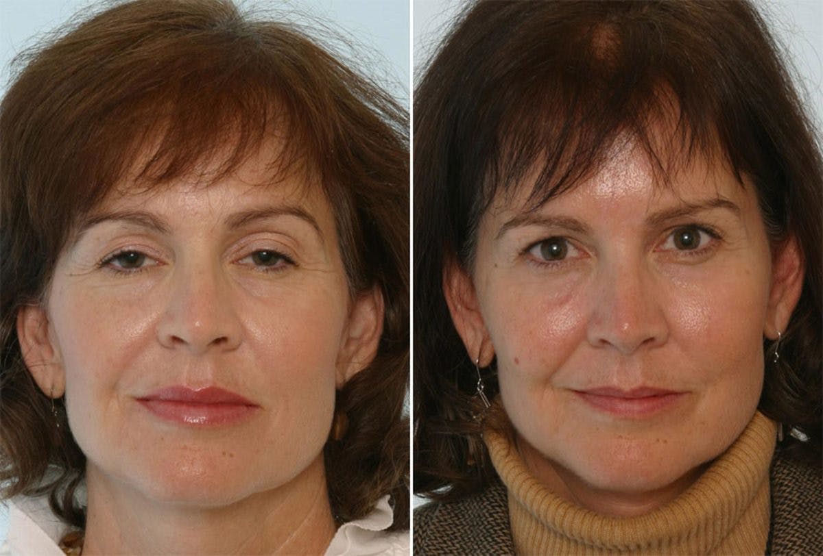 Fillers Before & After Gallery - Patient 55119286 - Image 1