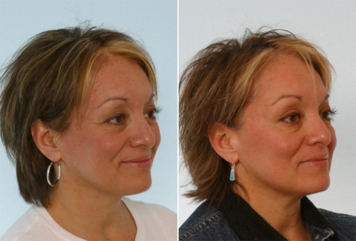 Fillers Before & After Gallery - Patient 55119287 - Image 2