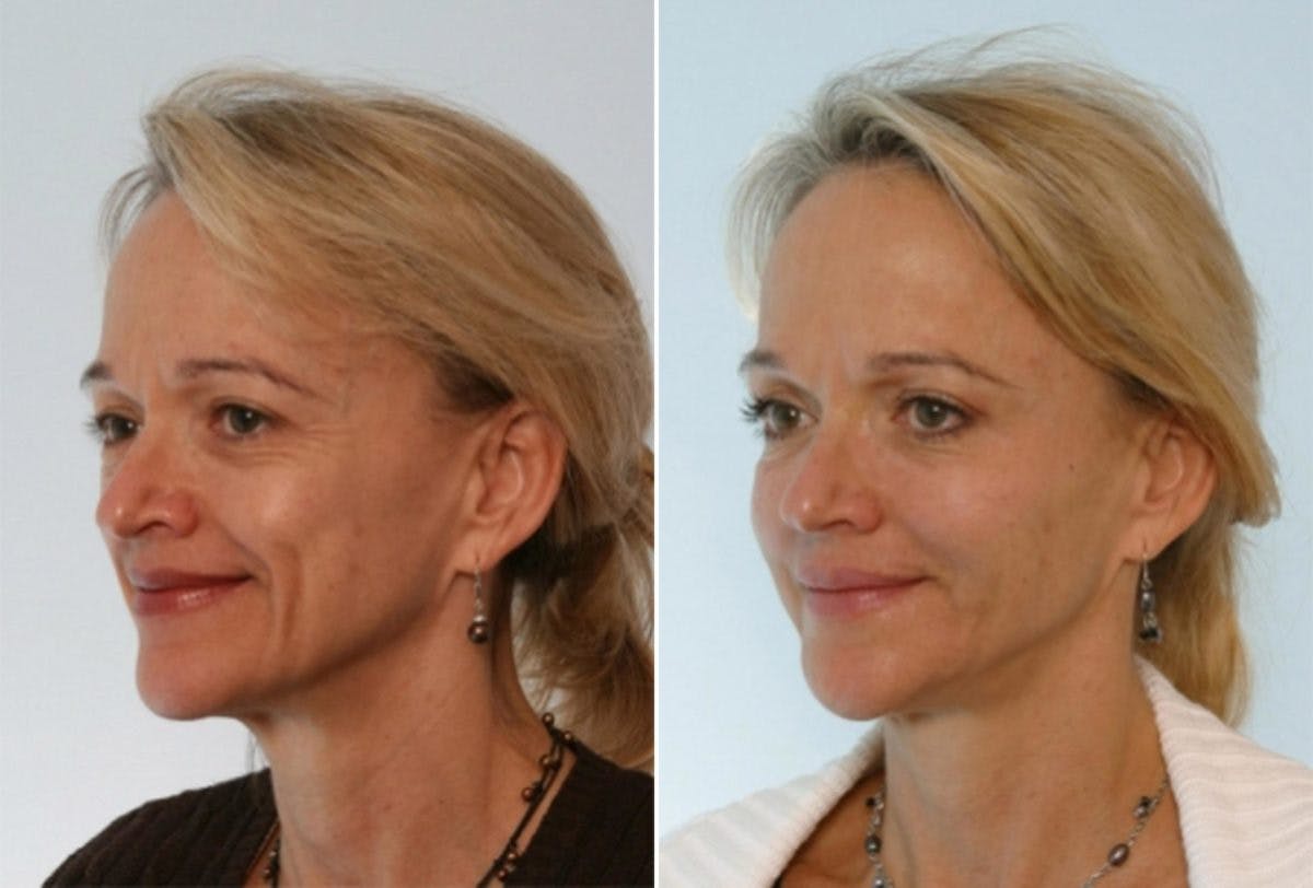 Fillers Before & After Gallery - Patient 55119288 - Image 2