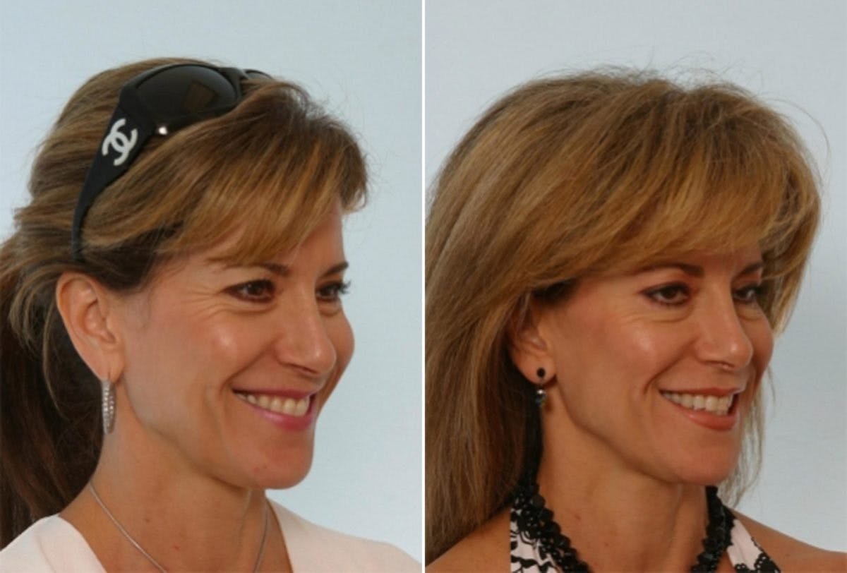 Fillers Before & After Gallery - Patient 55119289 - Image 2