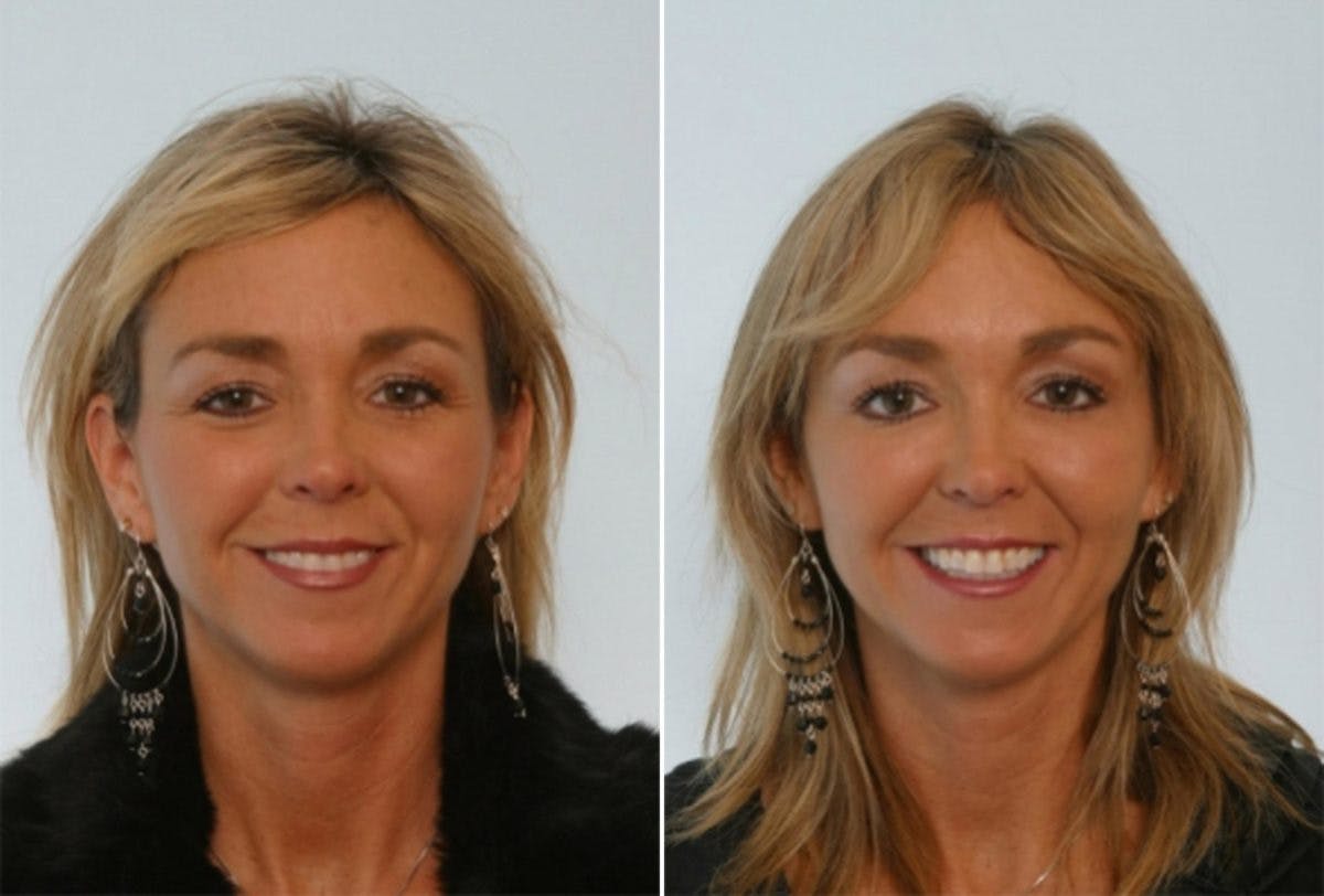 Fillers Before & After Gallery - Patient 55119291 - Image 1