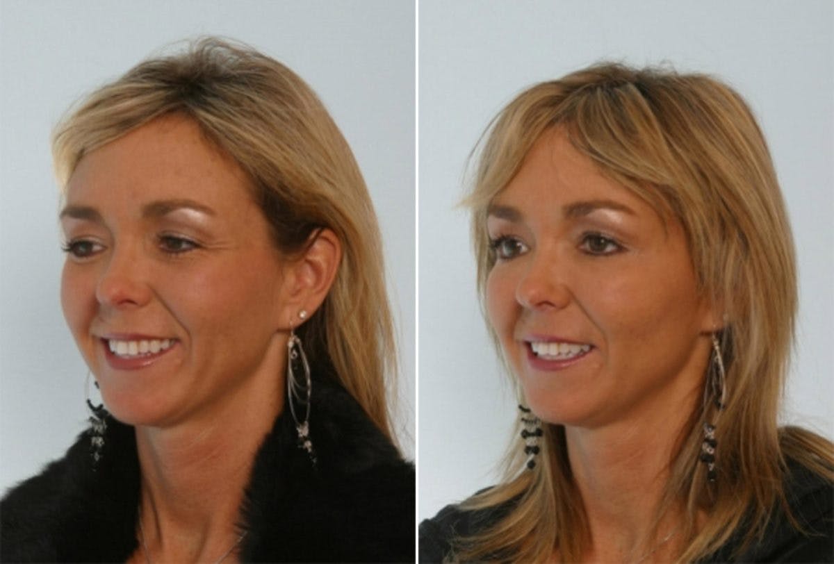 Fillers Before & After Gallery - Patient 55119291 - Image 2