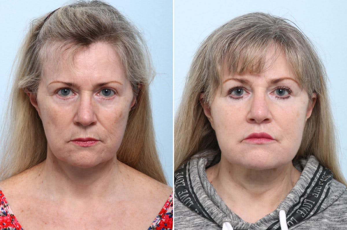 Lip Shortening Surgery Before & After Photo - Patient 55124217 - Image 1
