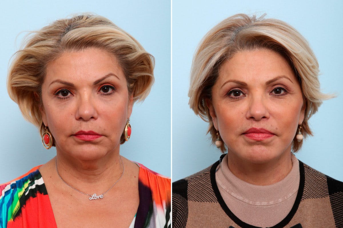 Lip Shortening Surgery Before & After Gallery - Patient 55124220 - Image 1