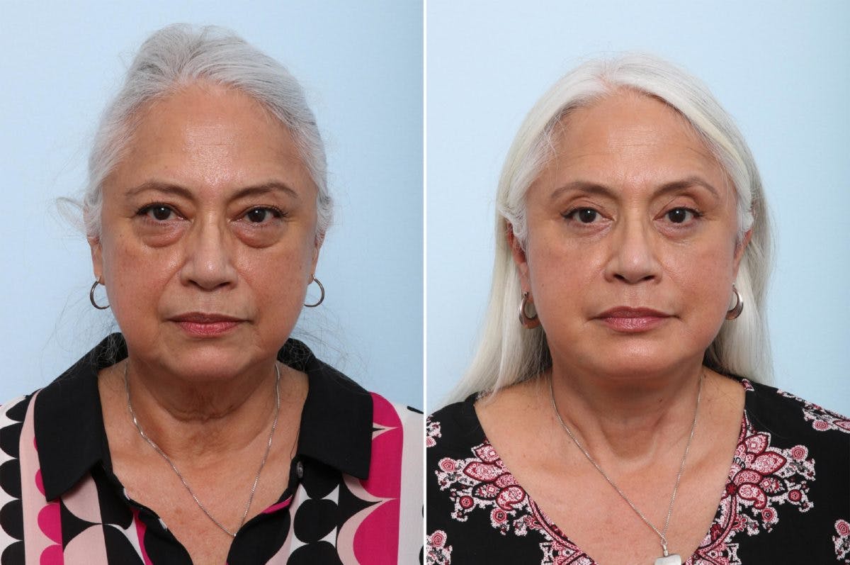 Lip Shortening Surgery Before & After Gallery - Patient 55124231 - Image 1