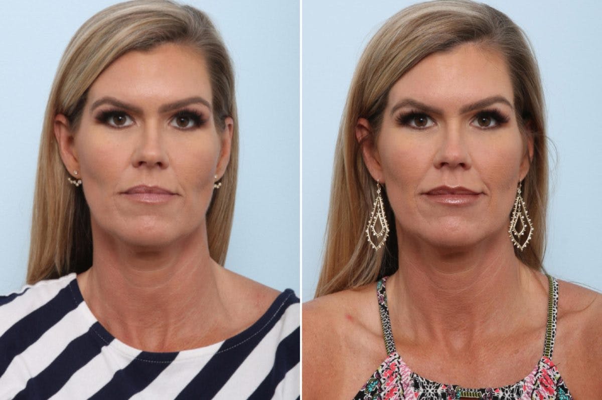 Juvederm Injectable Gel Before & After Gallery - Patient 55124245 - Image 1