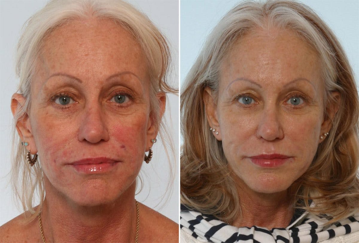 Juvederm Injectable Gel Before & After Gallery - Patient 55124252 - Image 1