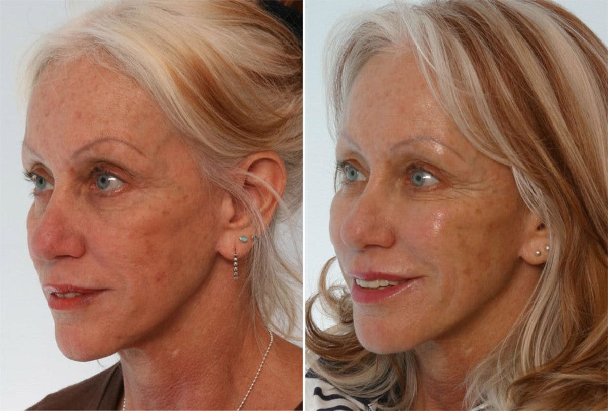 Juvederm Injectable Gel Before & After Gallery - Patient 55124252 - Image 2
