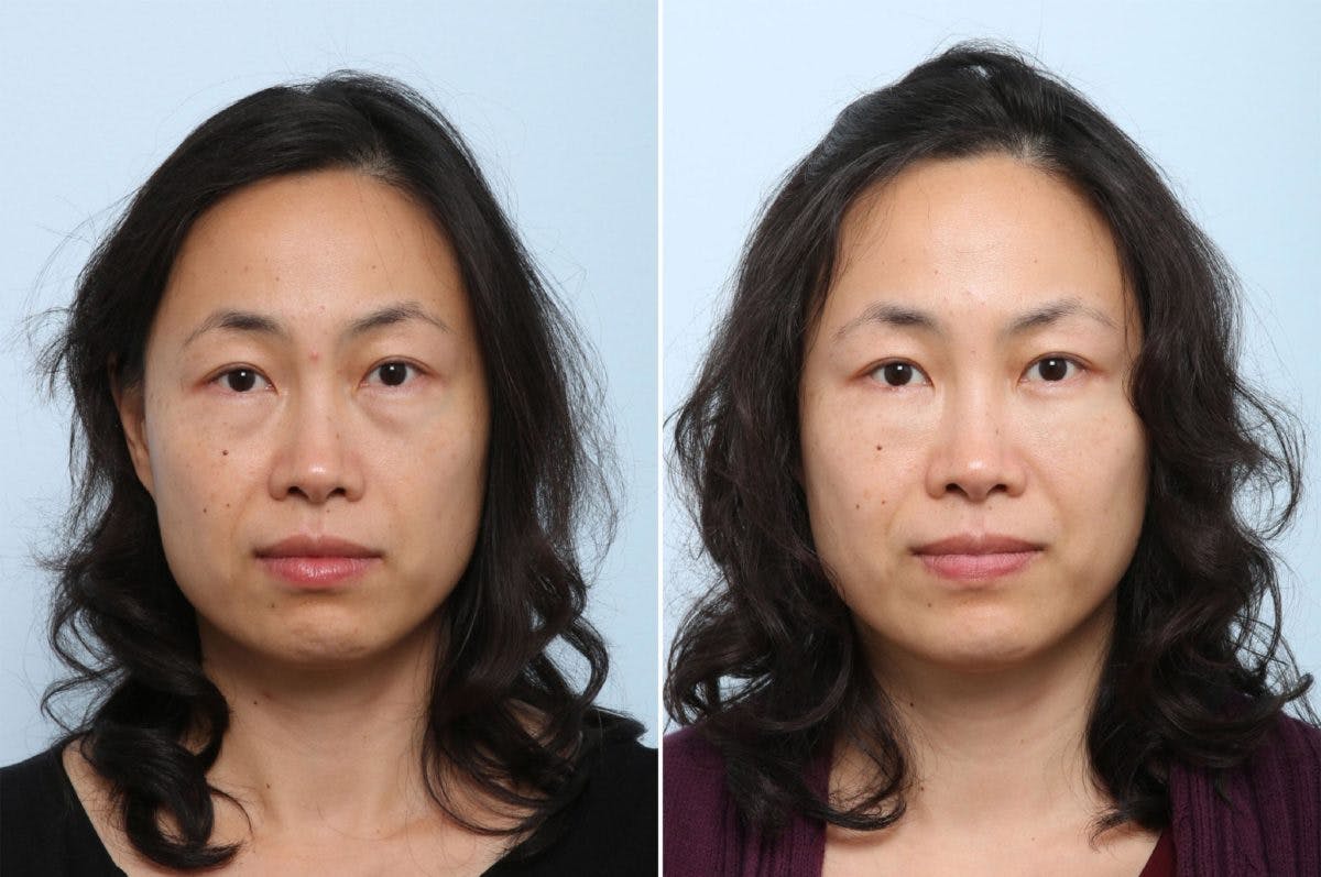 Juvederm Voluma XC Before & After Gallery - Patient 55124269 - Image 1