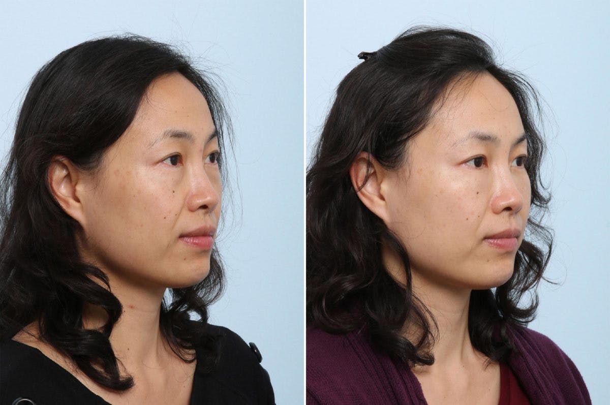 Juvederm Voluma XC Before & After Gallery - Patient 55124269 - Image 2