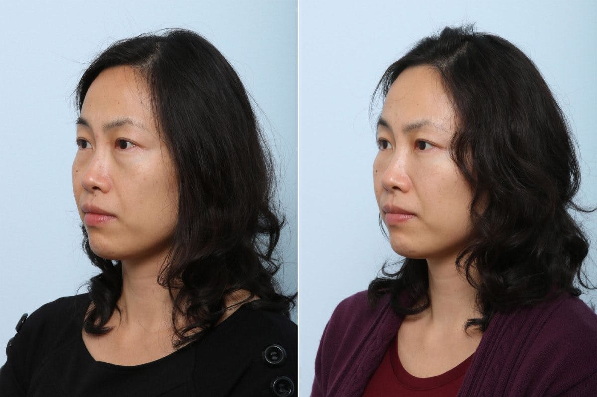 Juvederm Voluma XC Before & After Gallery - Patient 55124269 - Image 3