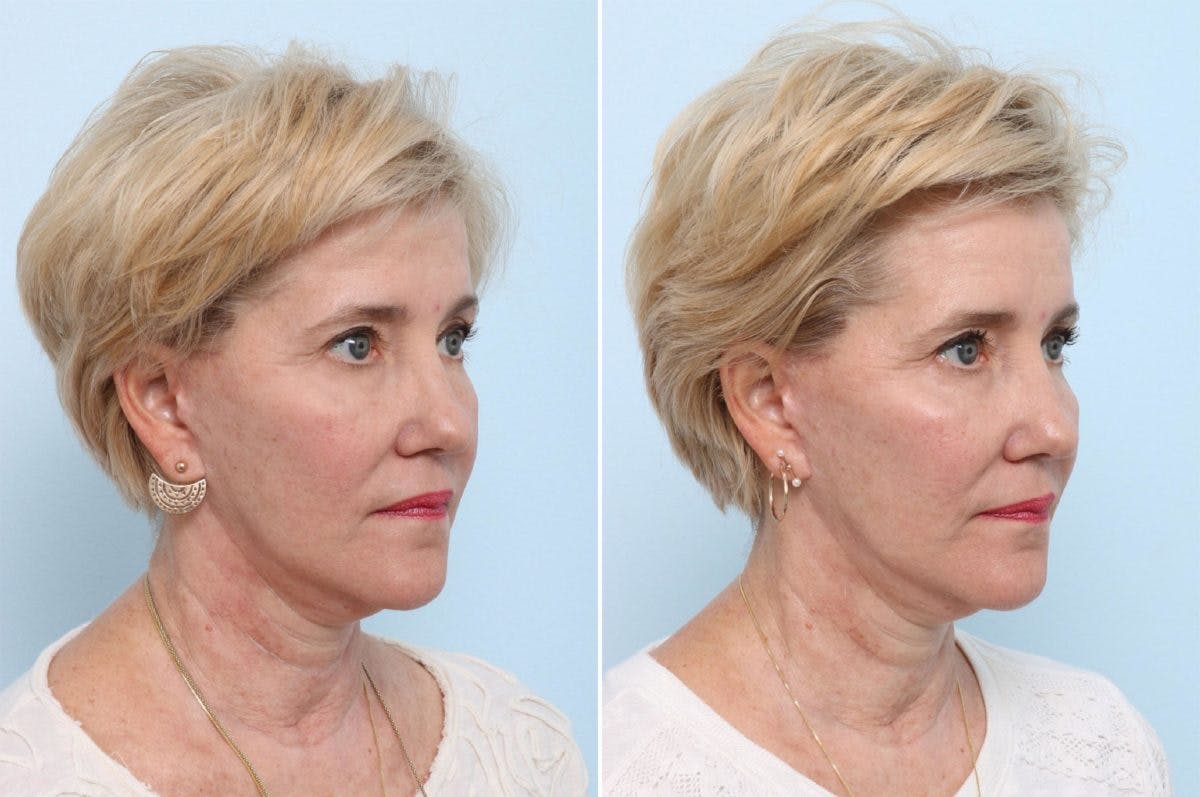 Juvederm Voluma XC Before & After Gallery - Patient 55124270 - Image 2