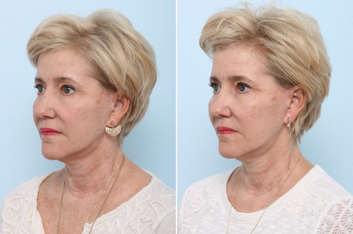 Juvederm Voluma XC Before & After Gallery - Patient 55124270 - Image 3