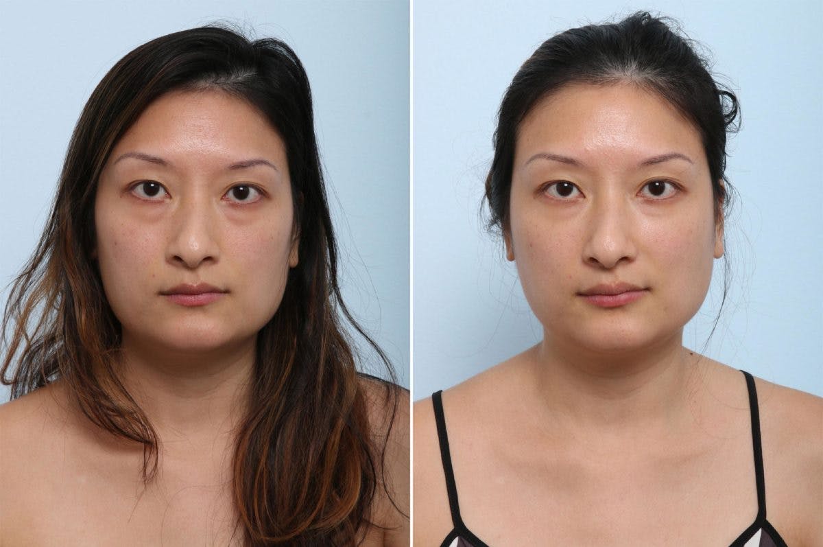 Juvederm Voluma XC Before & After Gallery - Patient 55124271 - Image 1
