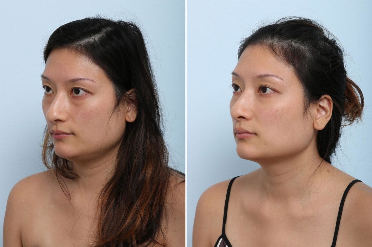 Juvederm Voluma XC Before & After Gallery - Patient 55124271 - Image 3