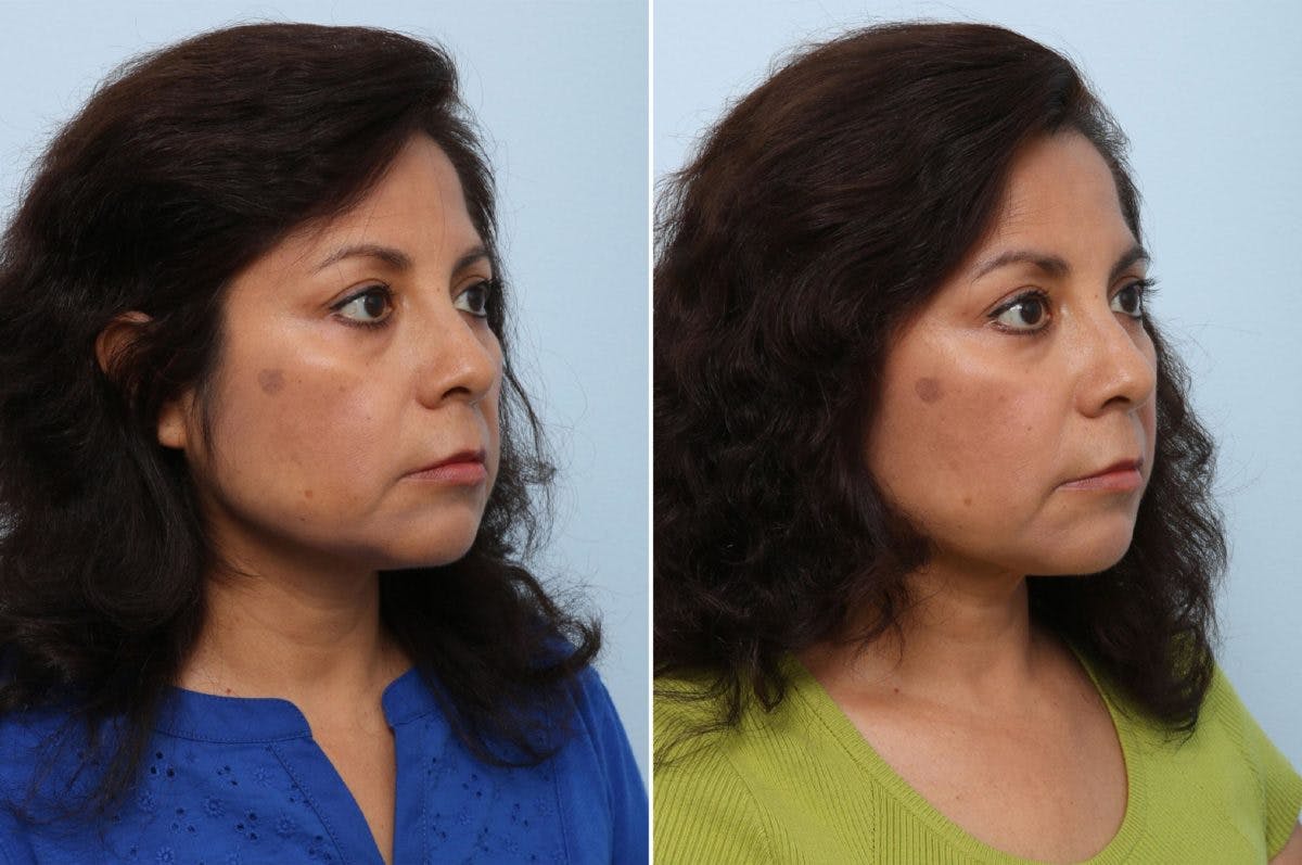 Juvederm Voluma XC Before & After Gallery - Patient 55124272 - Image 2