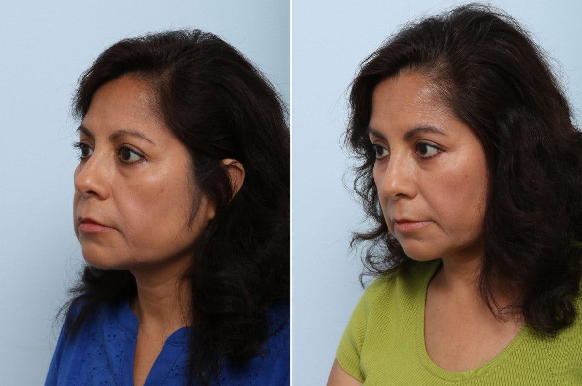 Juvederm Voluma XC Before & After Gallery - Patient 55124272 - Image 3
