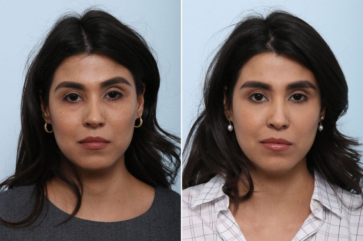 Juvederm Voluma XC Before & After Gallery - Patient 55124273 - Image 1