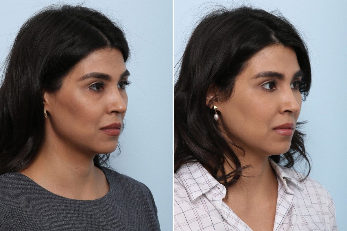 Juvederm Voluma XC Before & After Gallery - Patient 55124273 - Image 2