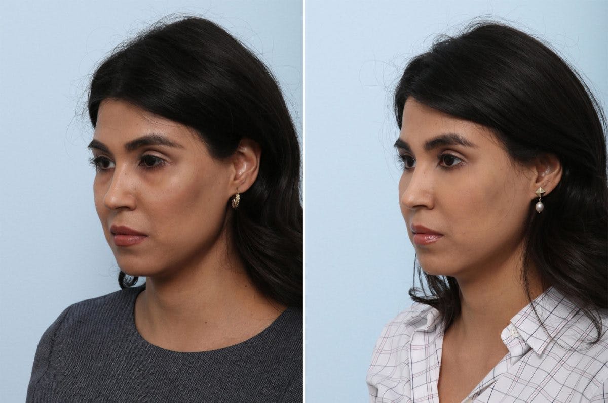 Juvederm Voluma XC Before & After Gallery - Patient 55124273 - Image 3
