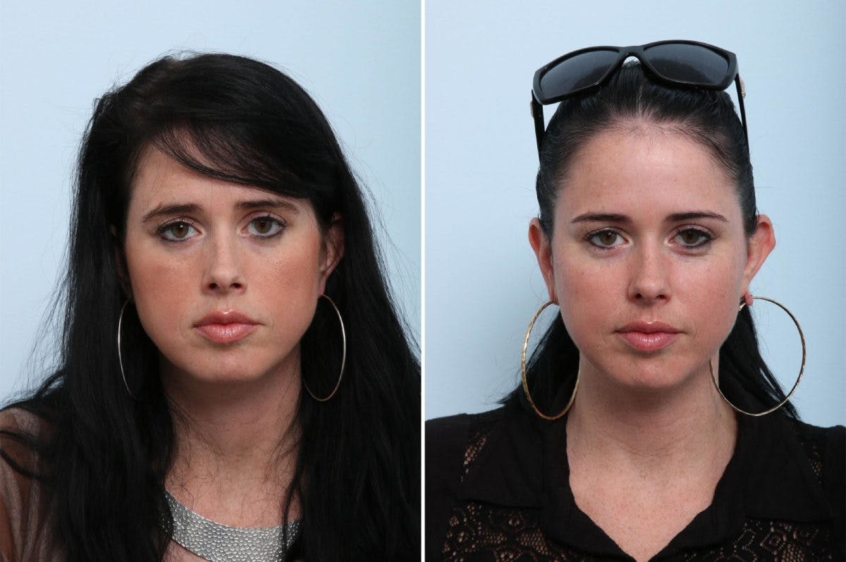 Juvederm Voluma XC Before & After Gallery - Patient 55124274 - Image 1