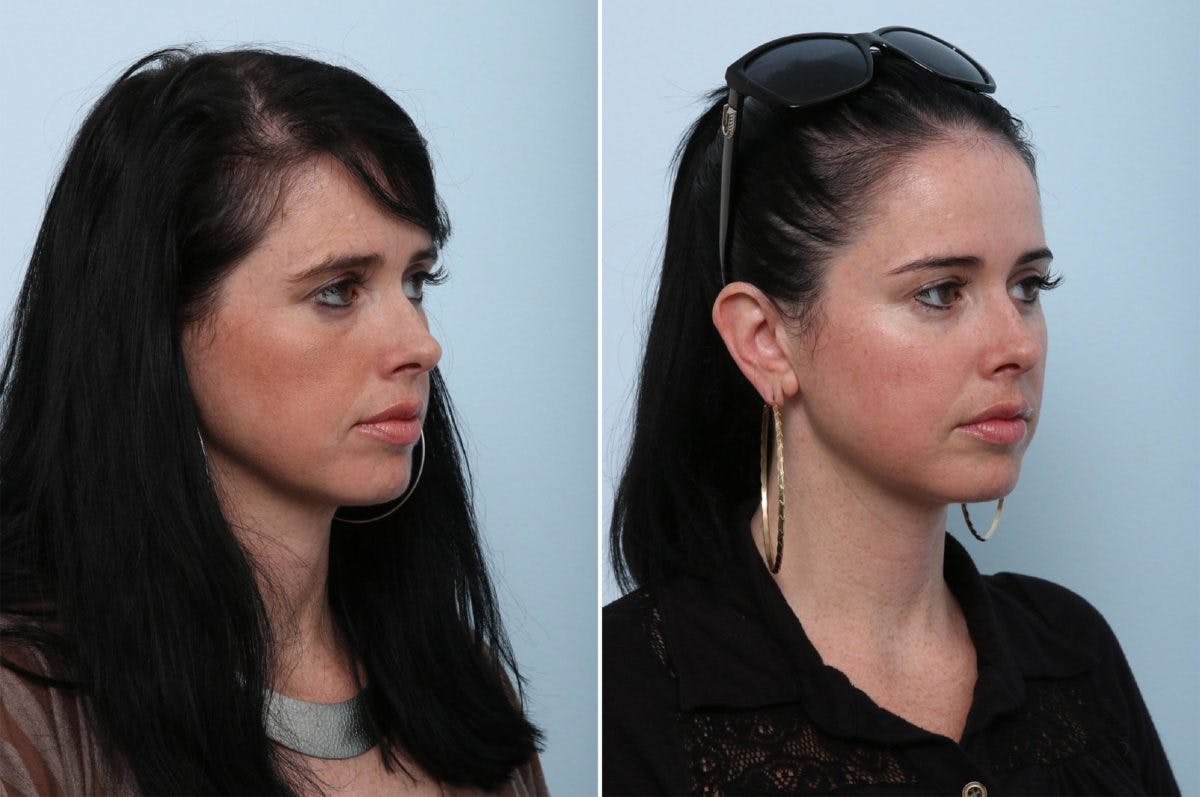 Juvederm Voluma XC Before & After Gallery - Patient 55124274 - Image 2