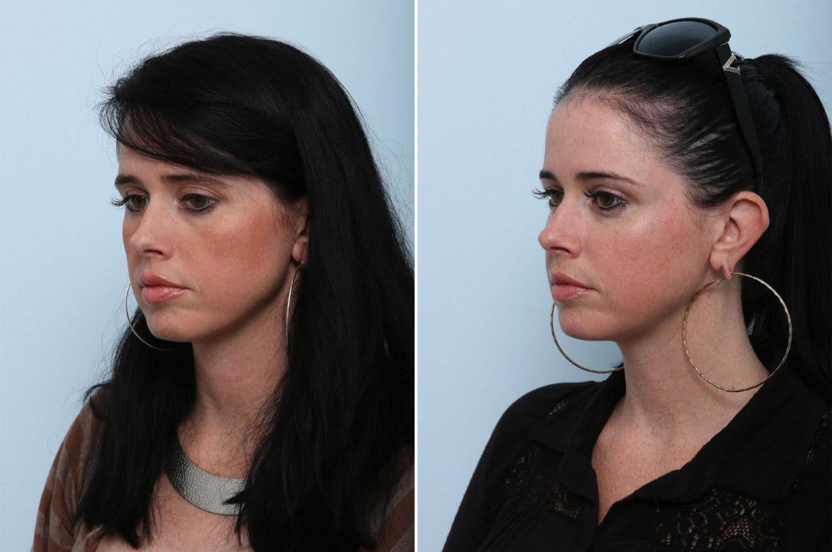 Juvederm Voluma XC Before & After Gallery - Patient 55124274 - Image 3
