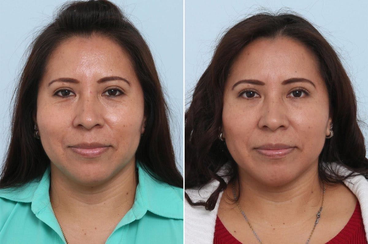 Juvederm Voluma XC Before & After Gallery - Patient 55124275 - Image 1