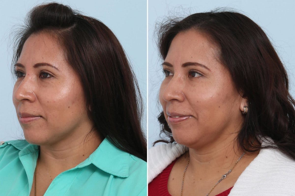 Juvederm Voluma XC Before & After Gallery - Patient 55124275 - Image 3