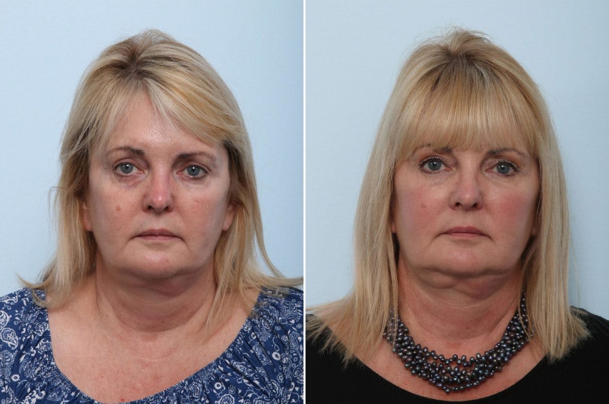 Juvederm Voluma XC Before & After Gallery - Patient 55124276 - Image 1