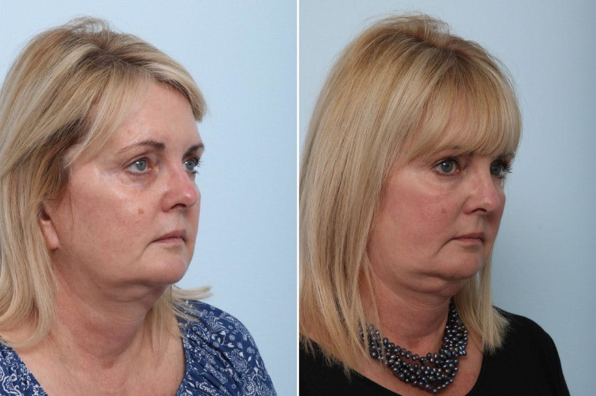 Juvederm Voluma XC Before & After Gallery - Patient 55124276 - Image 2