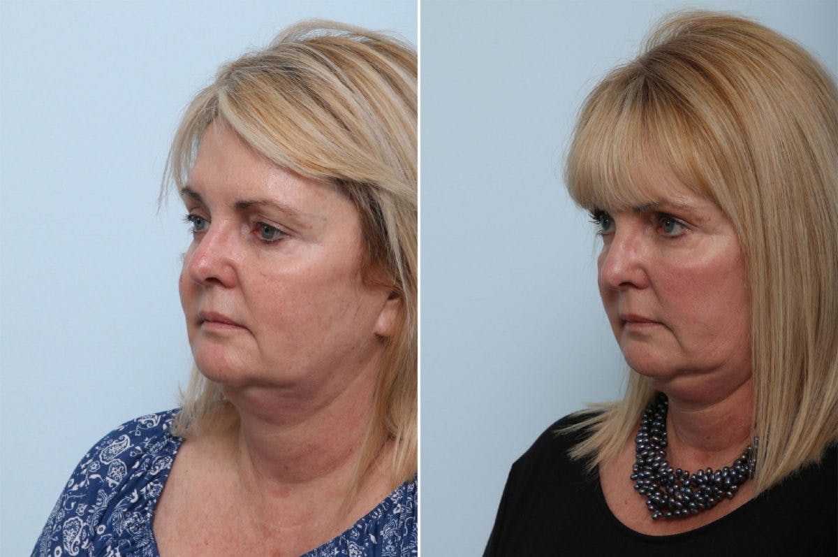 Juvederm Voluma XC Before & After Gallery - Patient 55124276 - Image 3