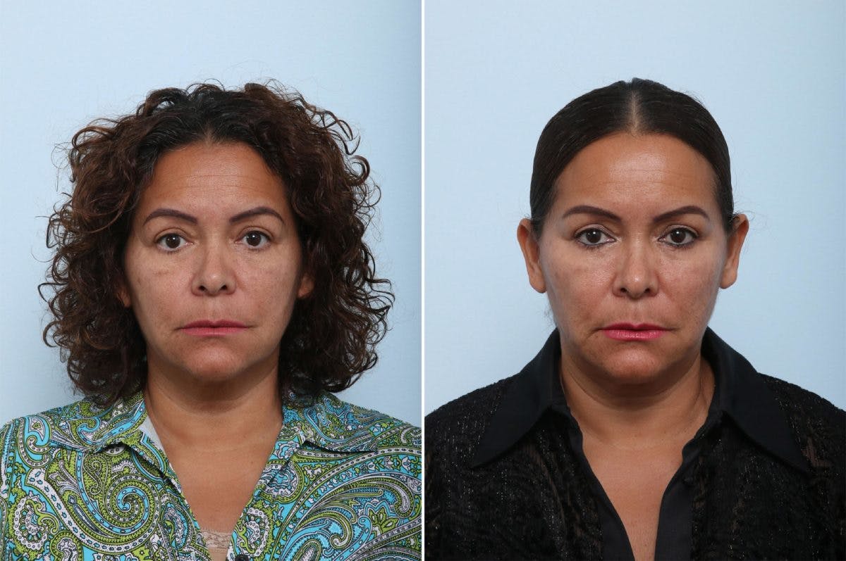 Juvederm Voluma XC Before & After Gallery - Patient 55124277 - Image 1