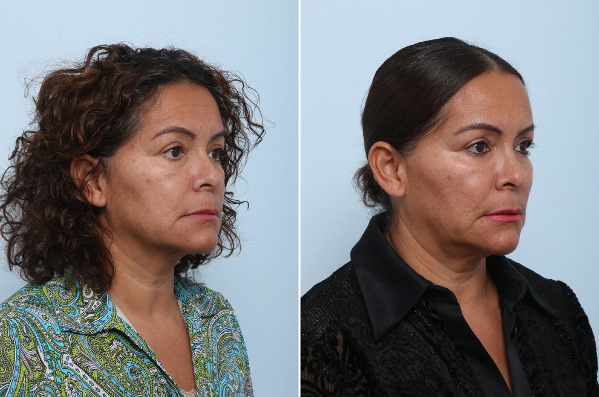 Juvederm Voluma XC Before & After Gallery - Patient 55124277 - Image 2