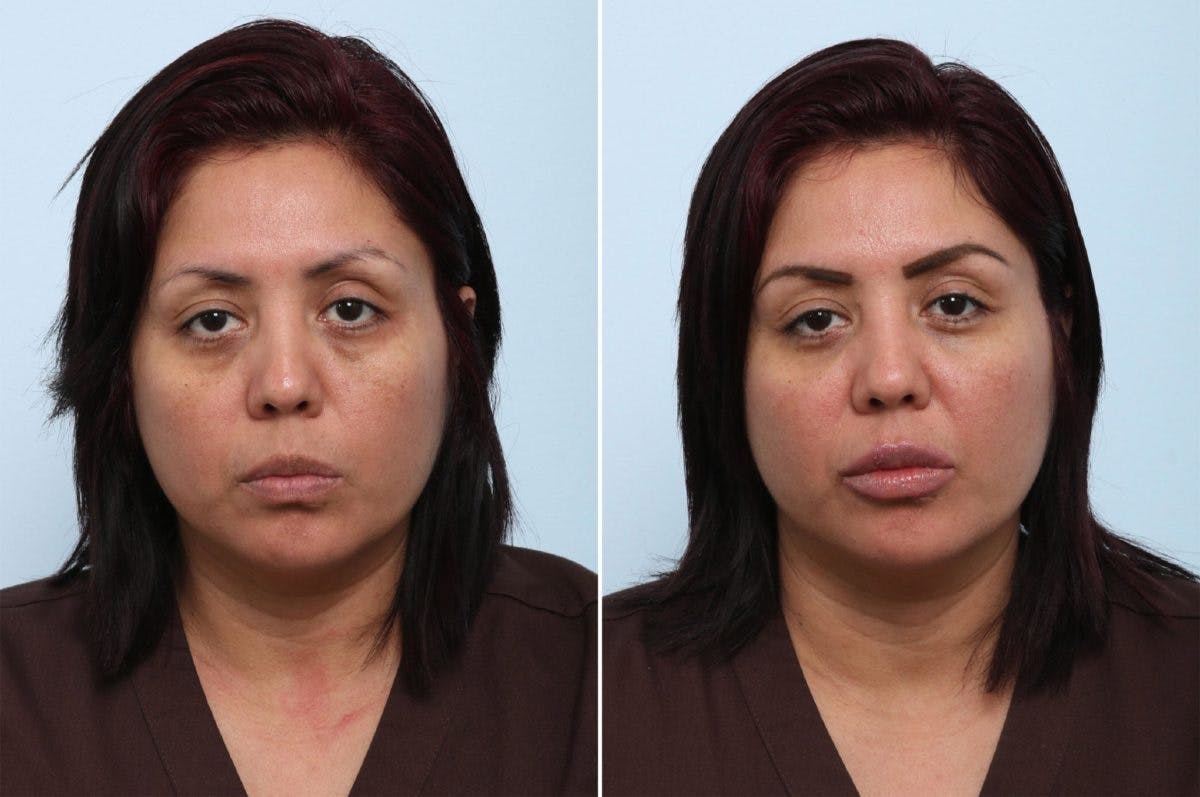 Juvederm Voluma XC Before & After Gallery - Patient 55124278 - Image 1