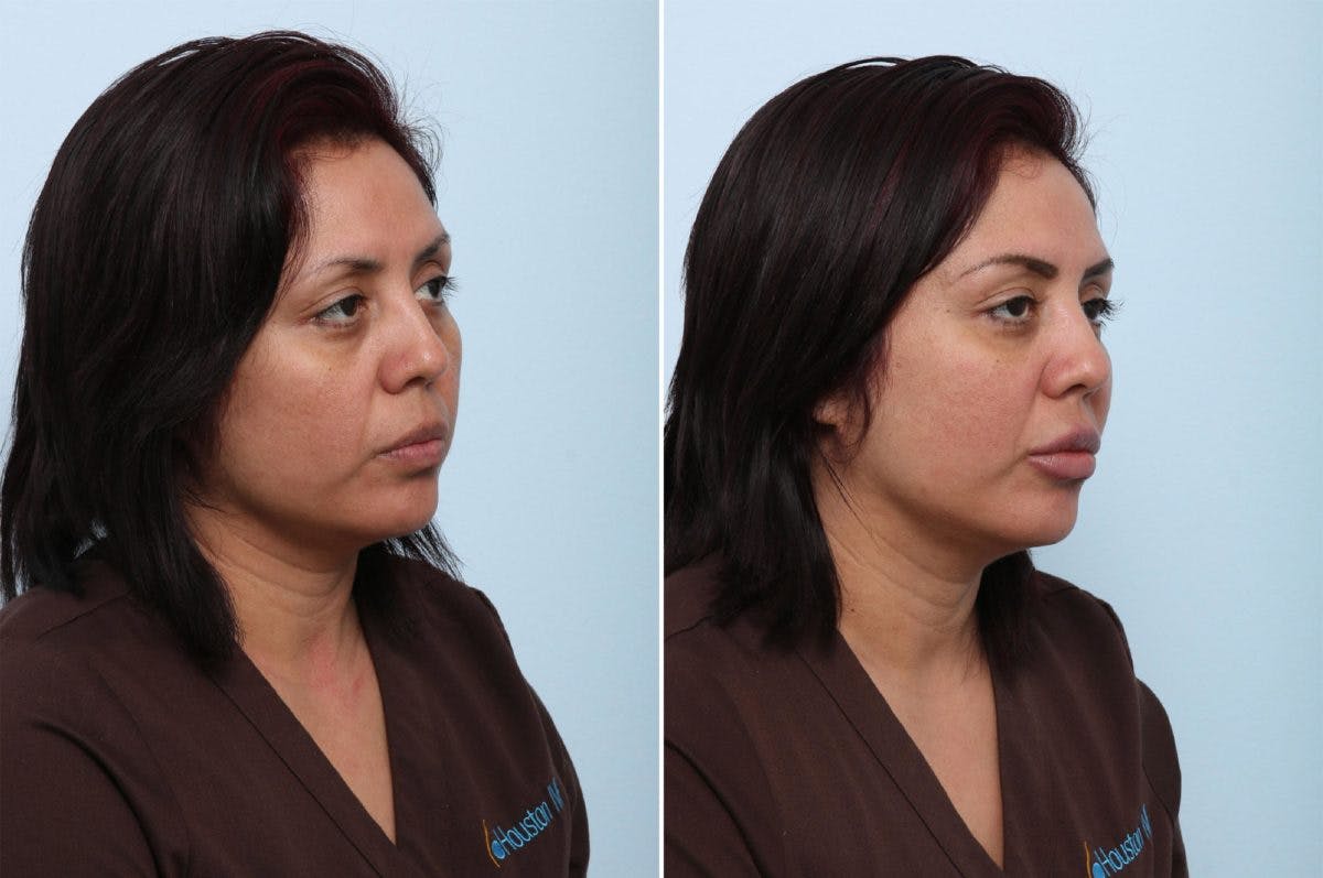 Juvederm Voluma XC Before & After Gallery - Patient 55124278 - Image 2