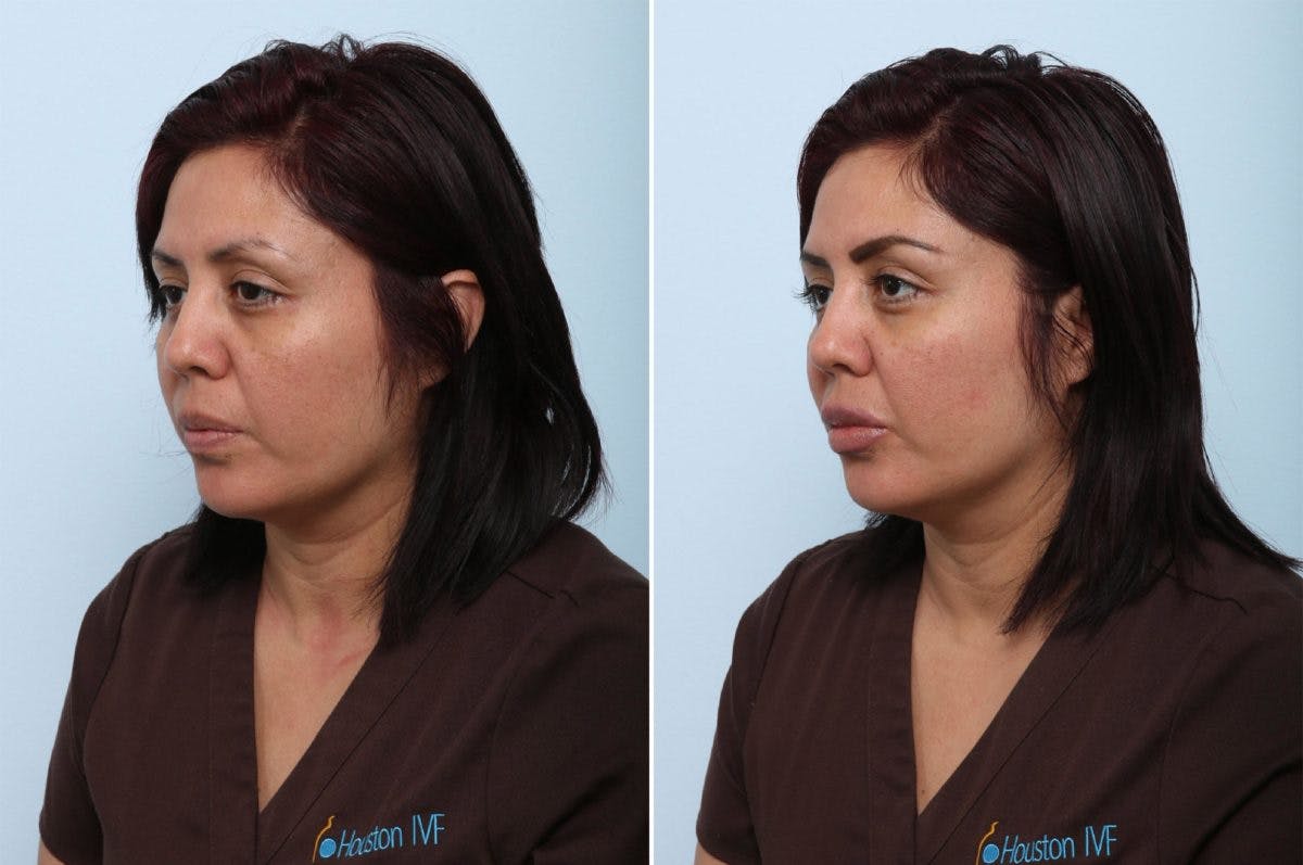 Juvederm Voluma XC Before & After Gallery - Patient 55124278 - Image 3