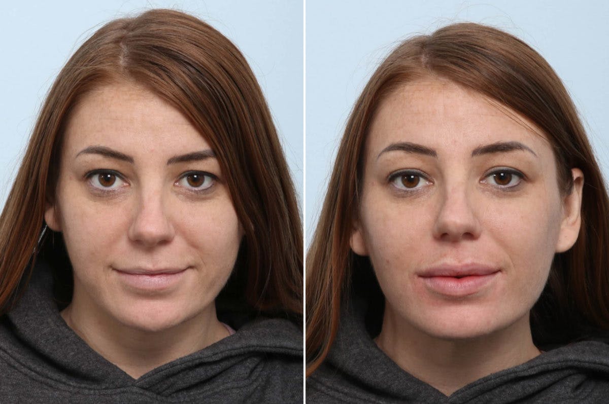 Lip Augmentation Before & After Photo - Patient 55171199 - Image 1