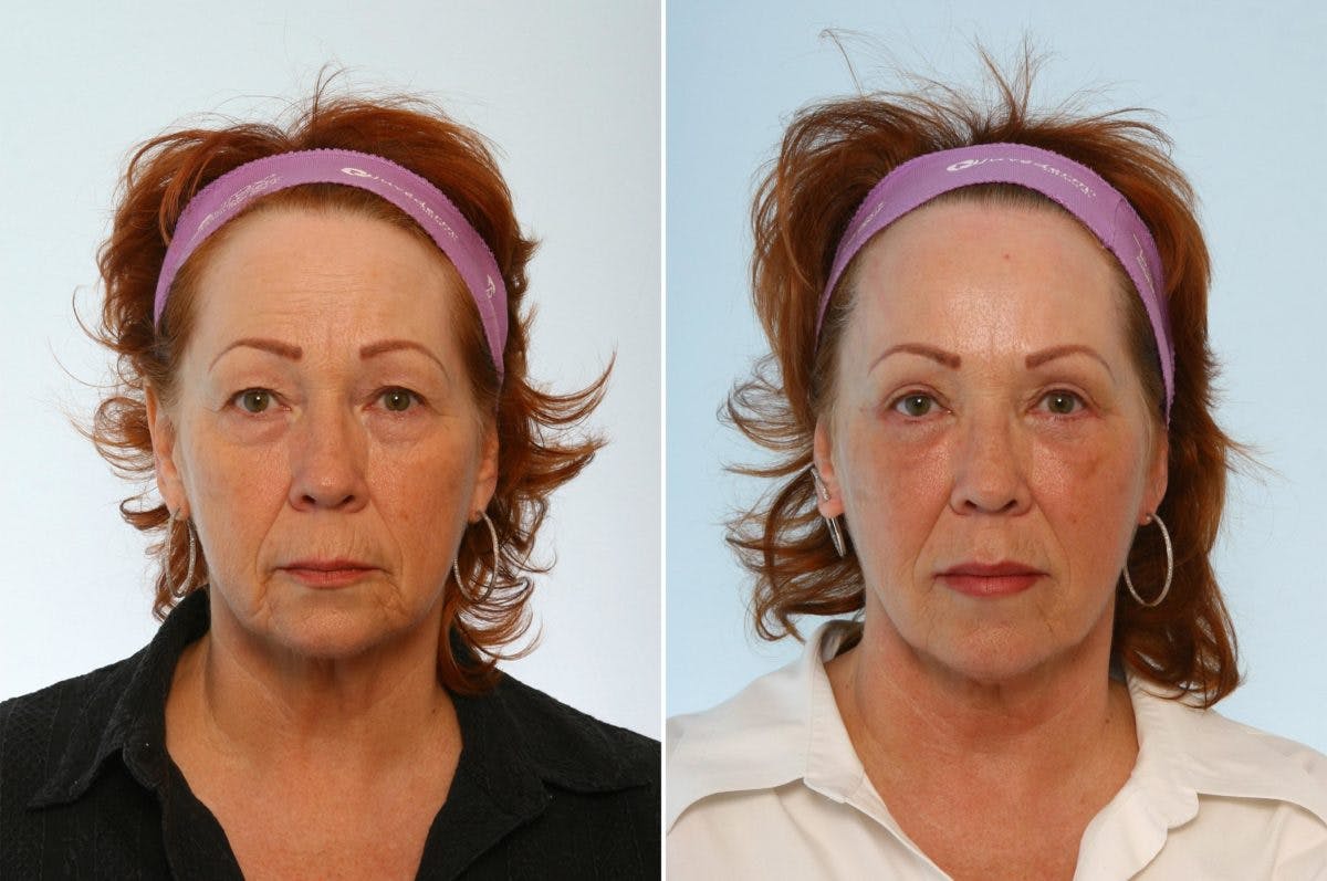 Lip Augmentation Before & After Gallery - Patient 55171208 - Image 1