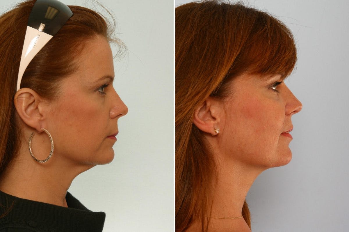 Neck Lift Before & After Photo - Patient 55171215 - Image 1