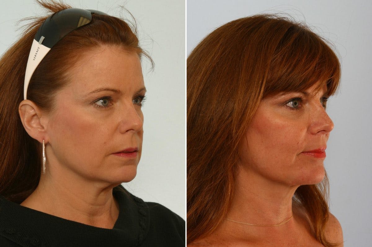 Neck Lift Before & After Gallery - Patient 55171215 - Image 2