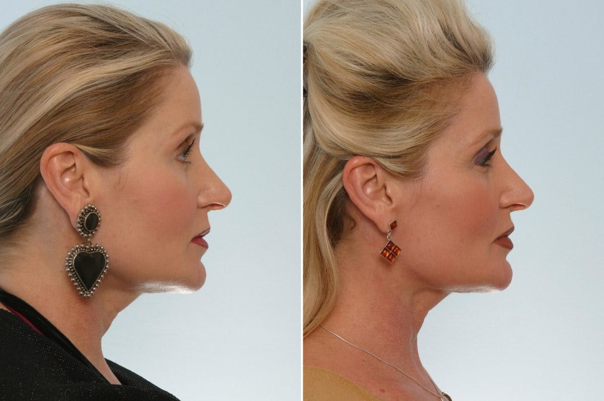 Neck Lift Before & After Gallery - Patient 55171216 - Image 1