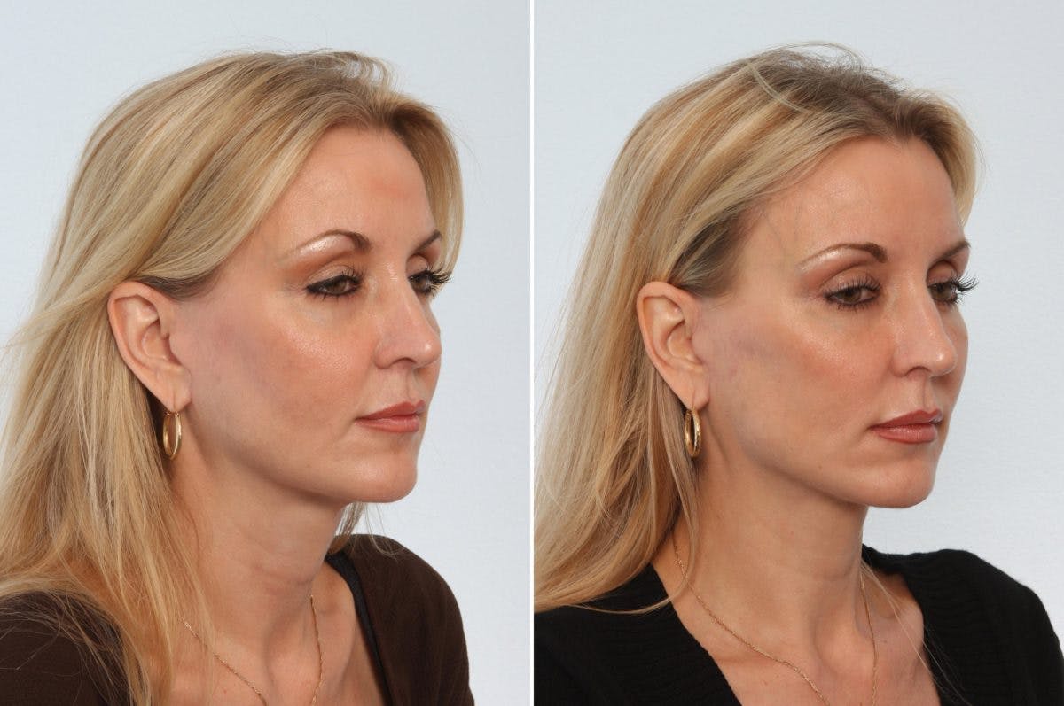 Neck Lift Before & After Gallery - Patient 55171220 - Image 2