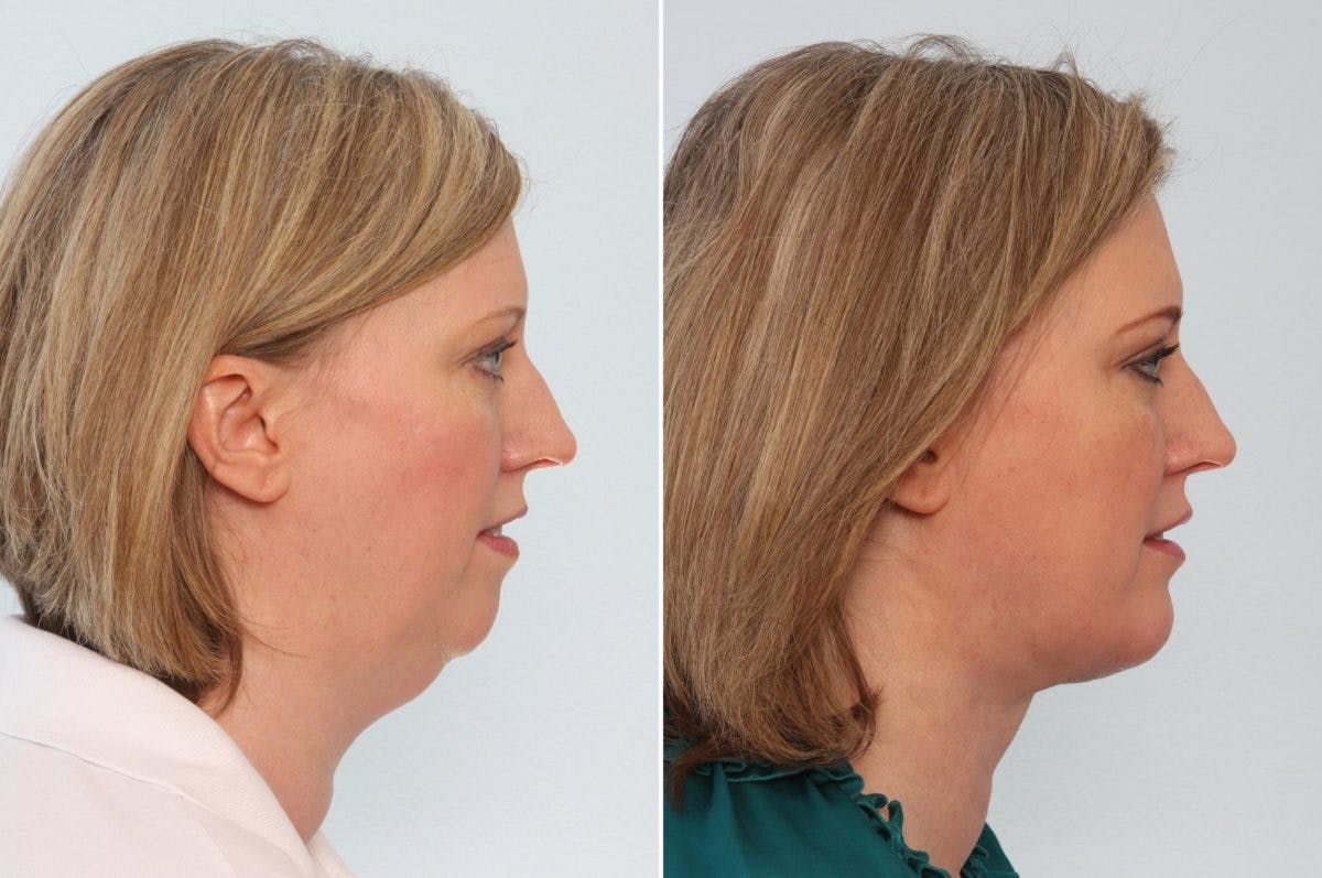 Neck Lift Before & After Photo - Patient 55171222 - Image 1