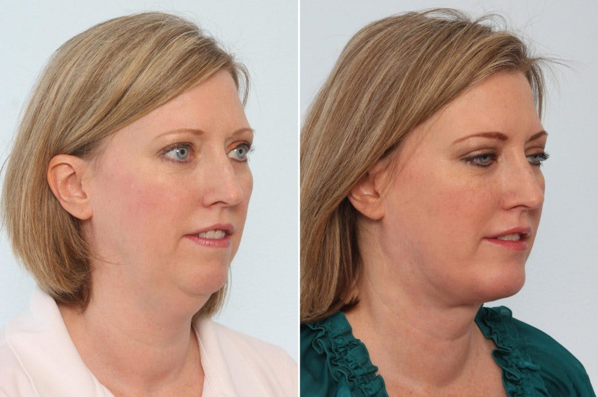 Neck Lift Before & After Gallery - Patient 55171222 - Image 2